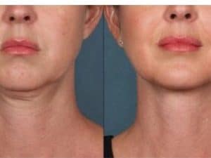 Harmonização Facial com Ozonioterapia